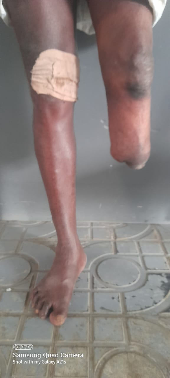 Support Subrahmanyam’s Artificial Leg