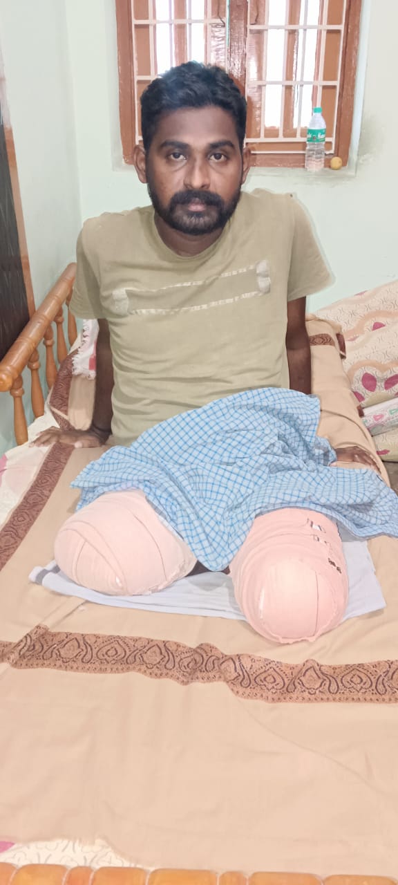 Two Artificial Legs = One New Future